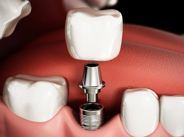 Dental Implants Penn Township