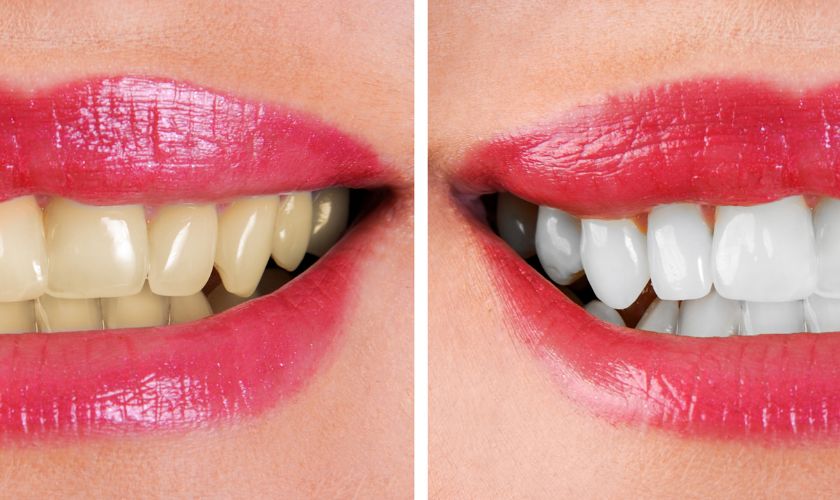 Science Behind Teeth Whitening | Pearl Dentistry Penn