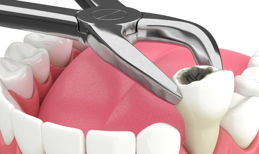 Tooth Extraction And Smoking