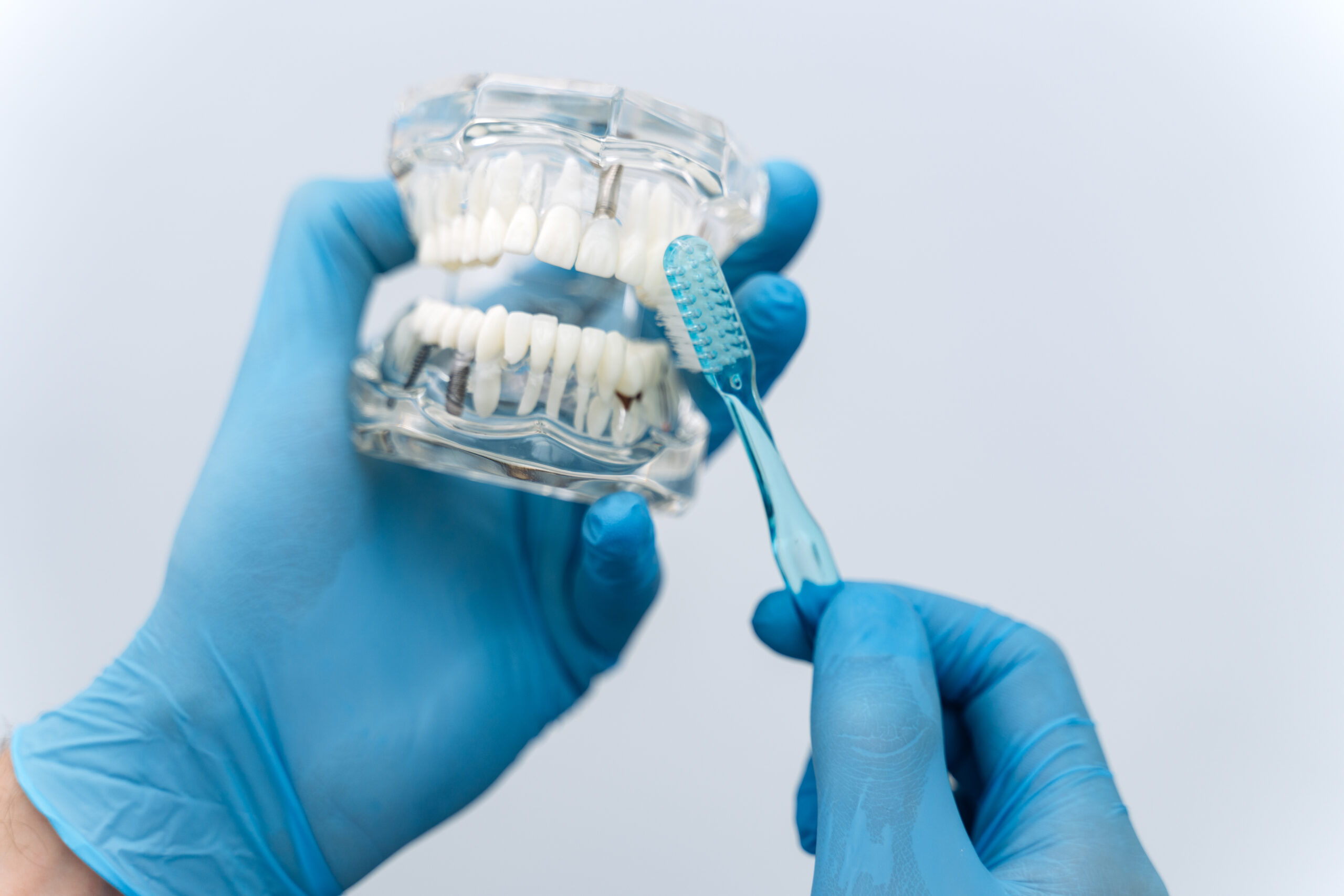 Tips for Cleaning Dental Implants