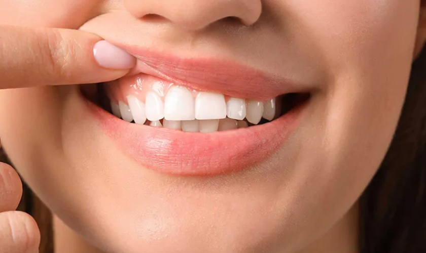 how long do gum grafts last