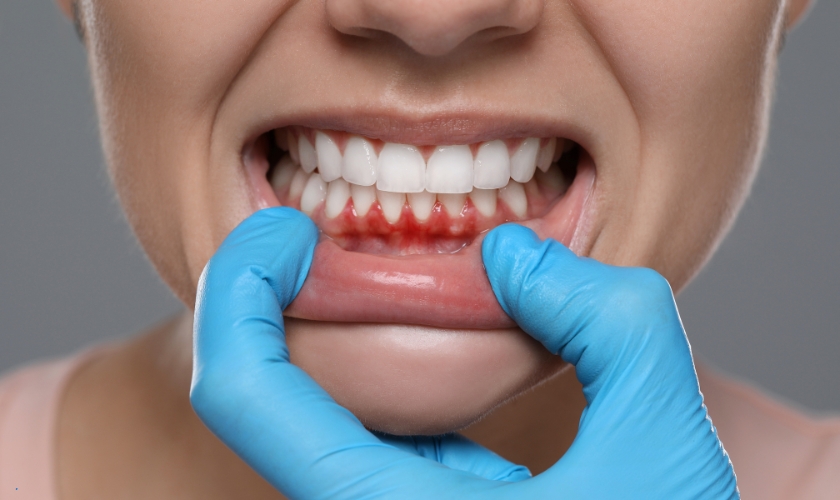 causes gums to turn red
