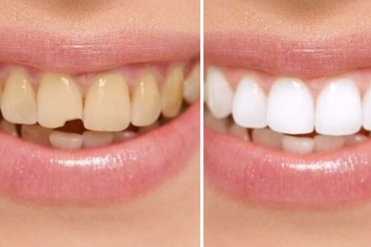Dental Bonding