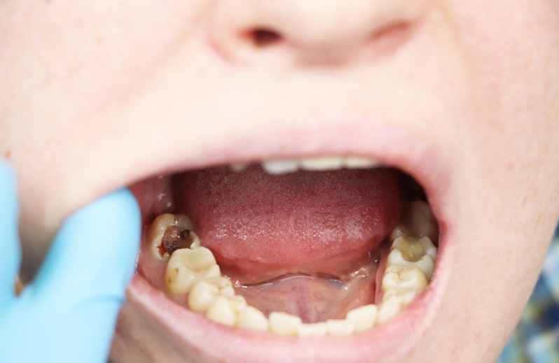 the steps to prevent cavities in children’s teeth